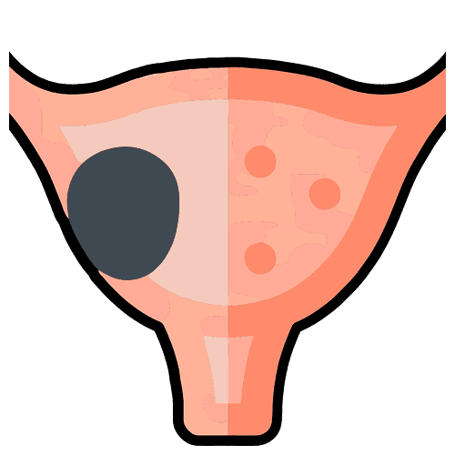 Bladder cancer