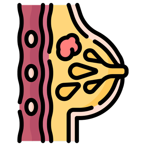 Breast cancer