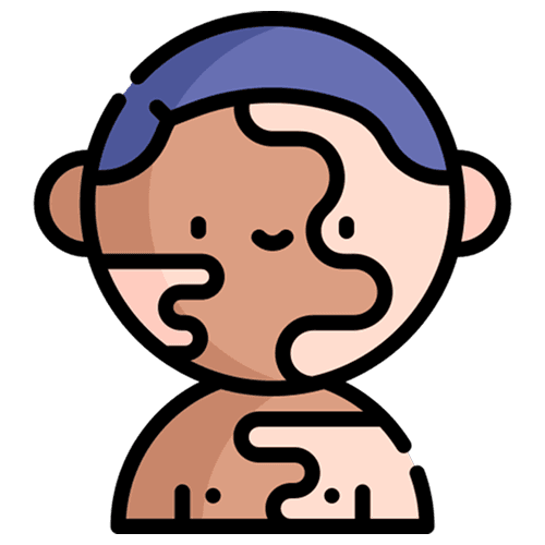 Systemic Lupus Erythematosus